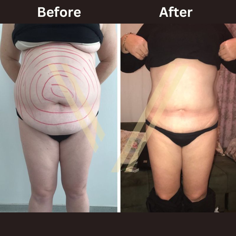 La liposuccion VASER en Turquie
