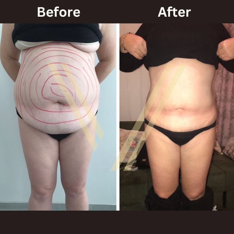 Before and after tummy liposuction female patient result