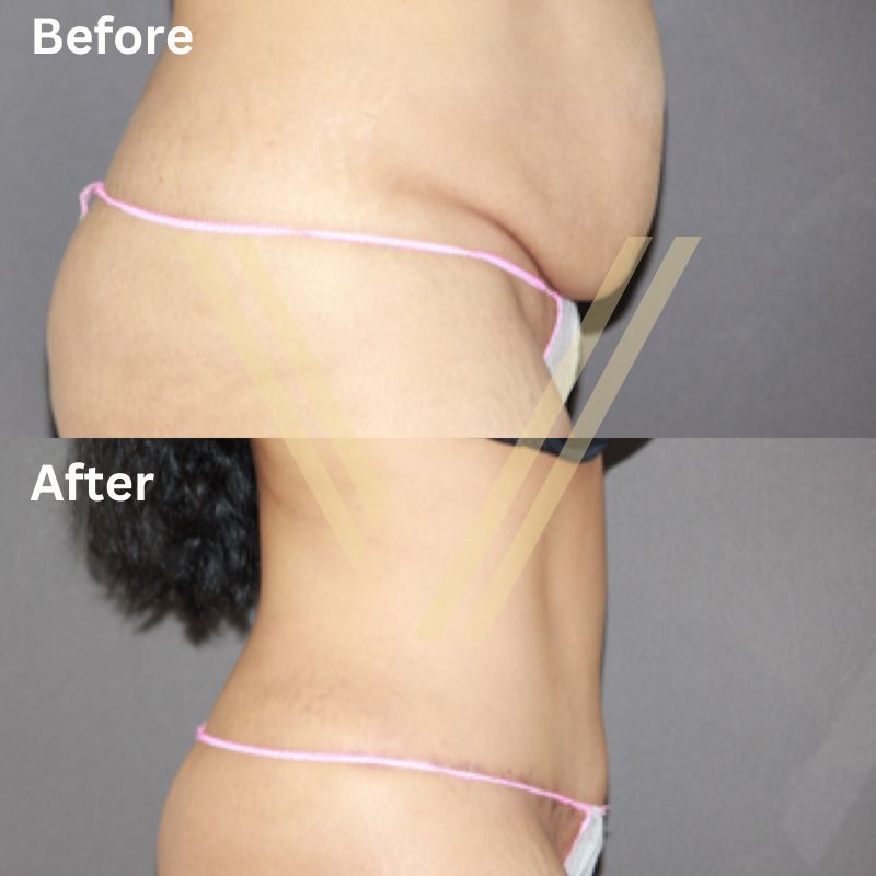 Before & after tummy tuck female patient result