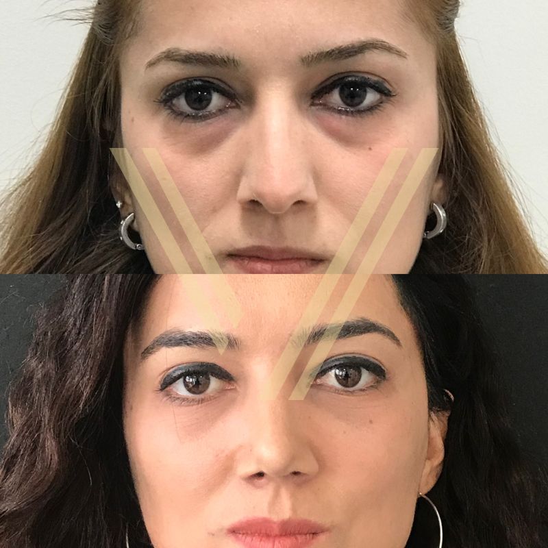 Blepharoplasty before after woman before after photo