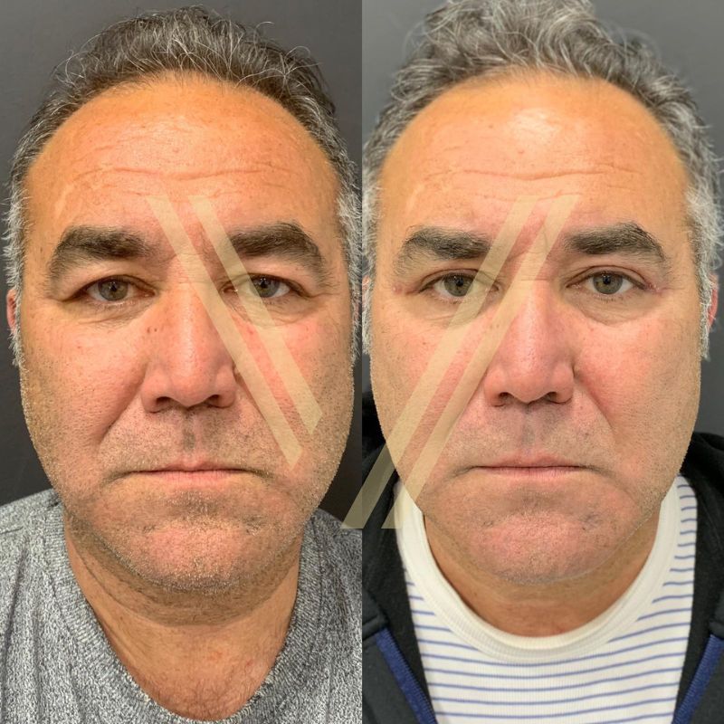 Blepharoplasty eyelid surgery male patient before after vantage