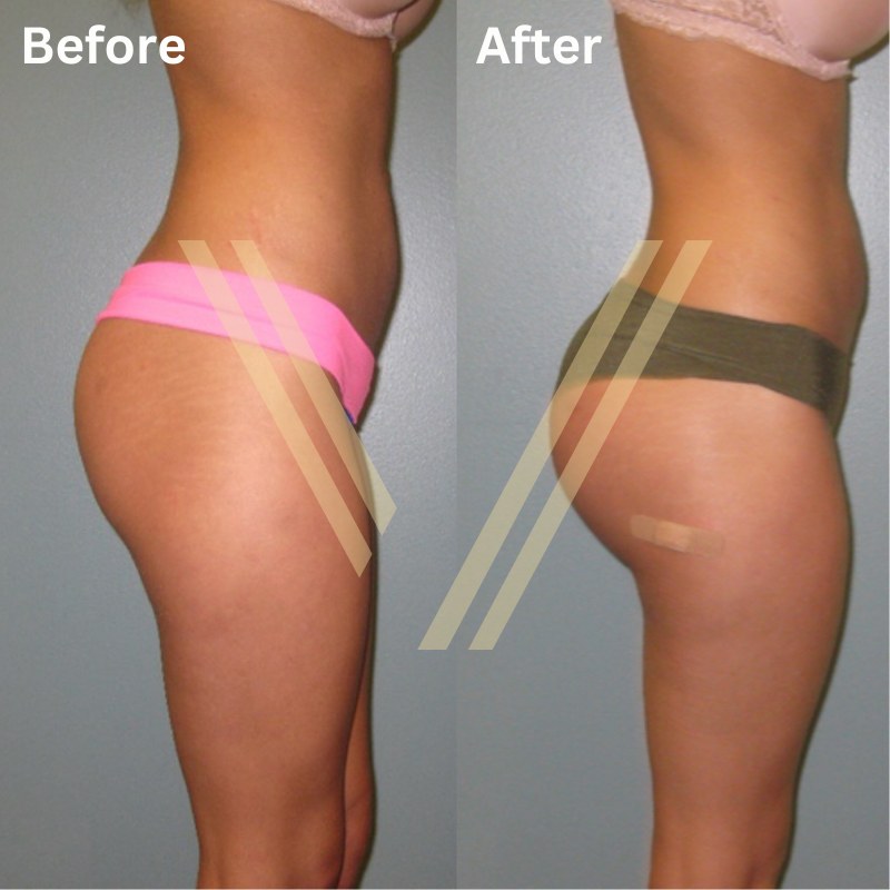 Bum implants in Turkey Before and After photo