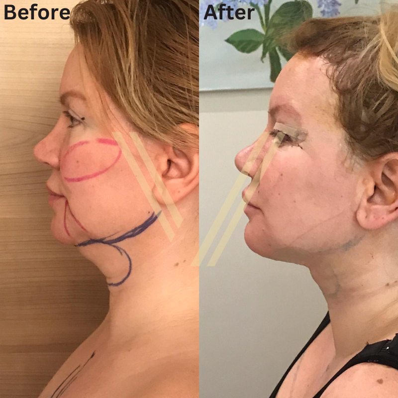 Chin augmentation with liposuction before and after