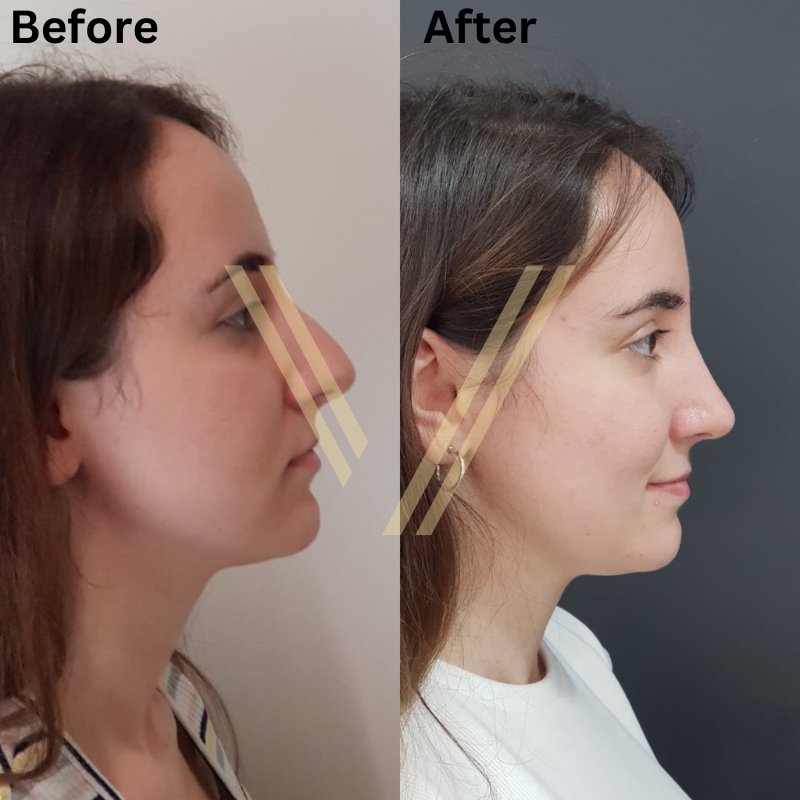 Rhinoplasty before after vantage clinic istanbul