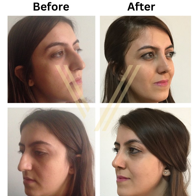 Rhinoplasty job before after female patient 4 photos
