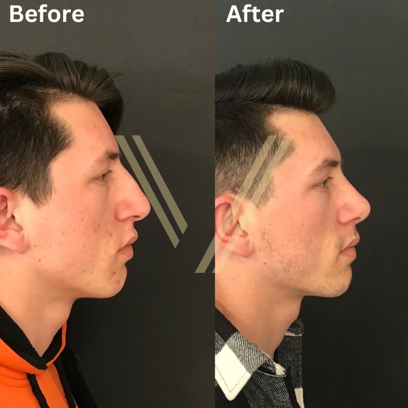 Rhinoplasty turkey male patient before after