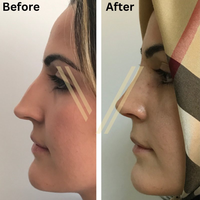Turkish female patient nose job before and after female patient at vantage aesthetics turkey