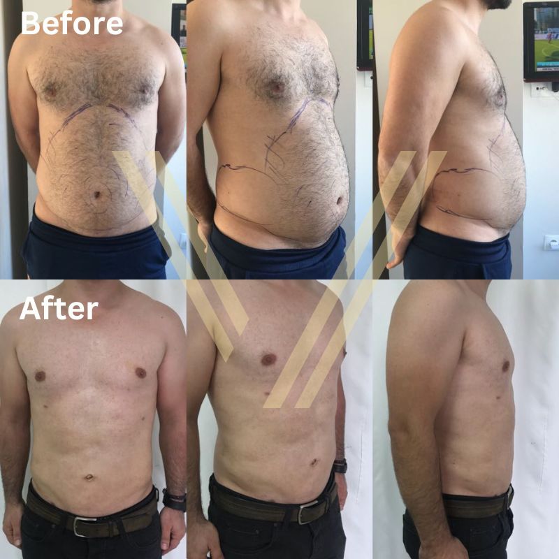 abdominal belly 6 pack liposuction before after male patient at vantage aesthetics clinic