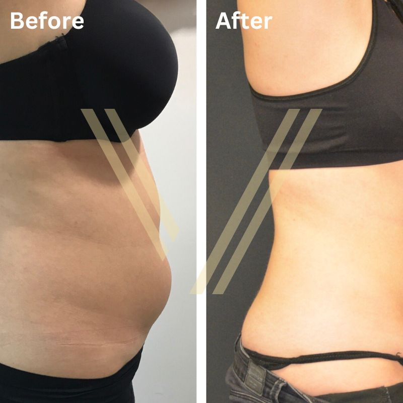 belly liposuction before and after result at vantage aesthetics clinic turkey