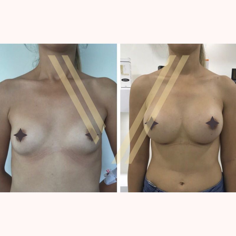 boob augmentatio before after result vantage clinic turkey