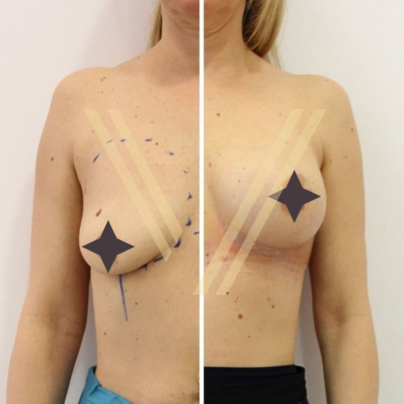 boob lift surgery difference at vantage aesthetic clinic