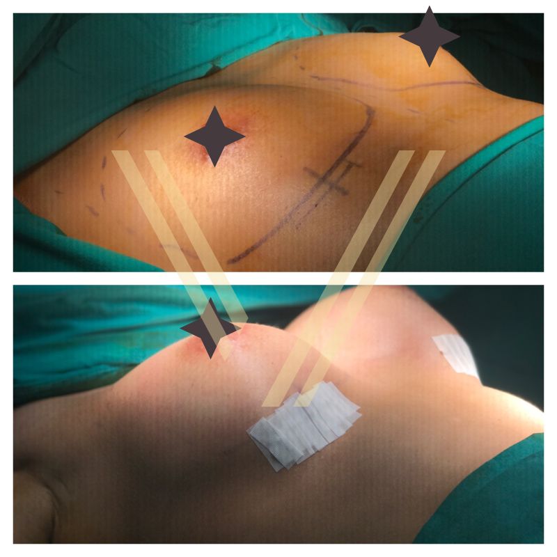 breast augmentation after the operation difference