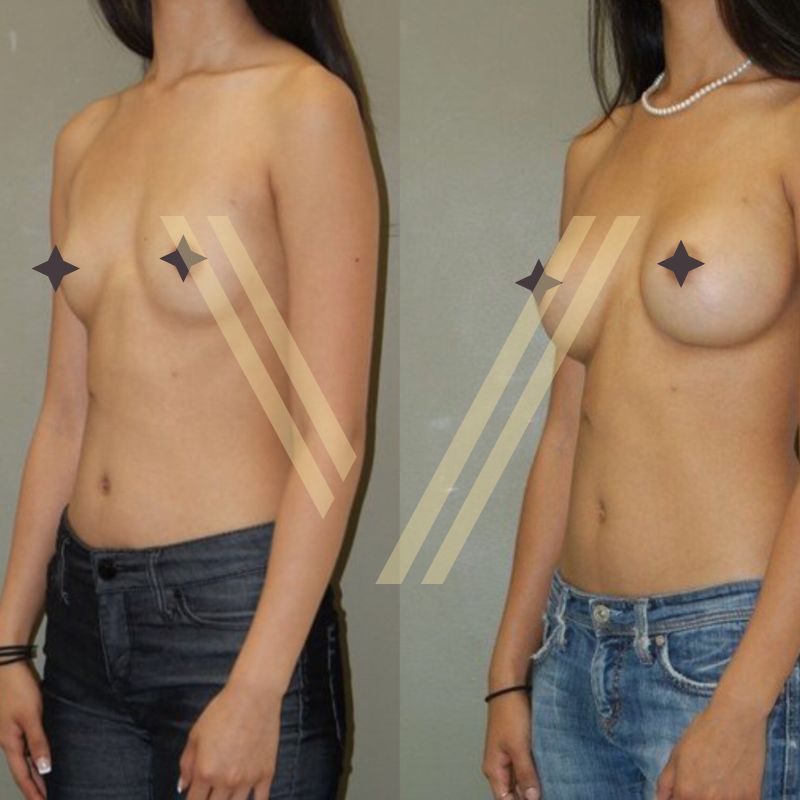 breast augmentation surgery before after vantage aesthetics