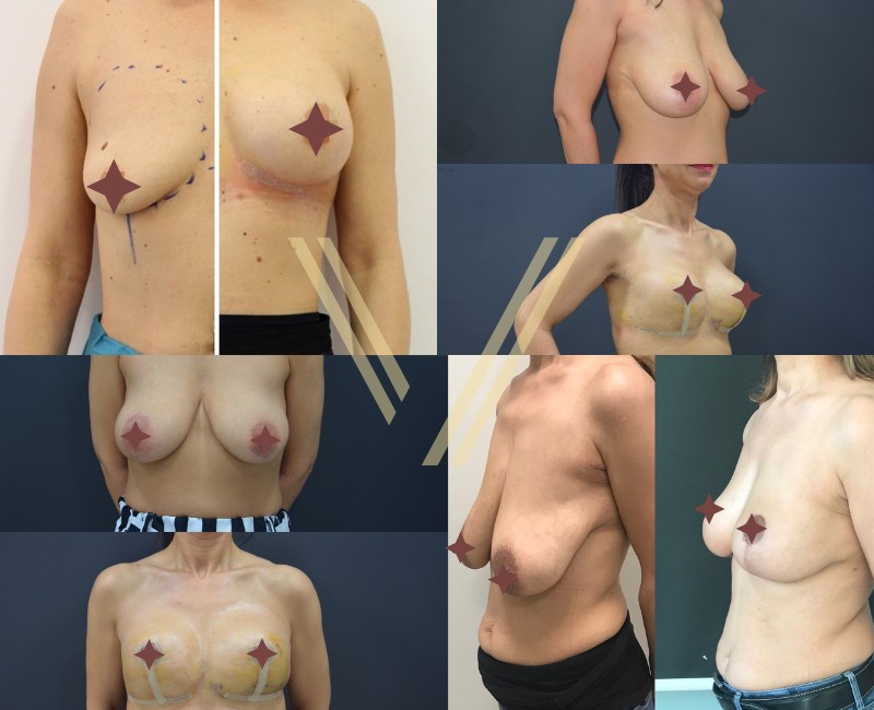 breast lift before and after photos 4 patients