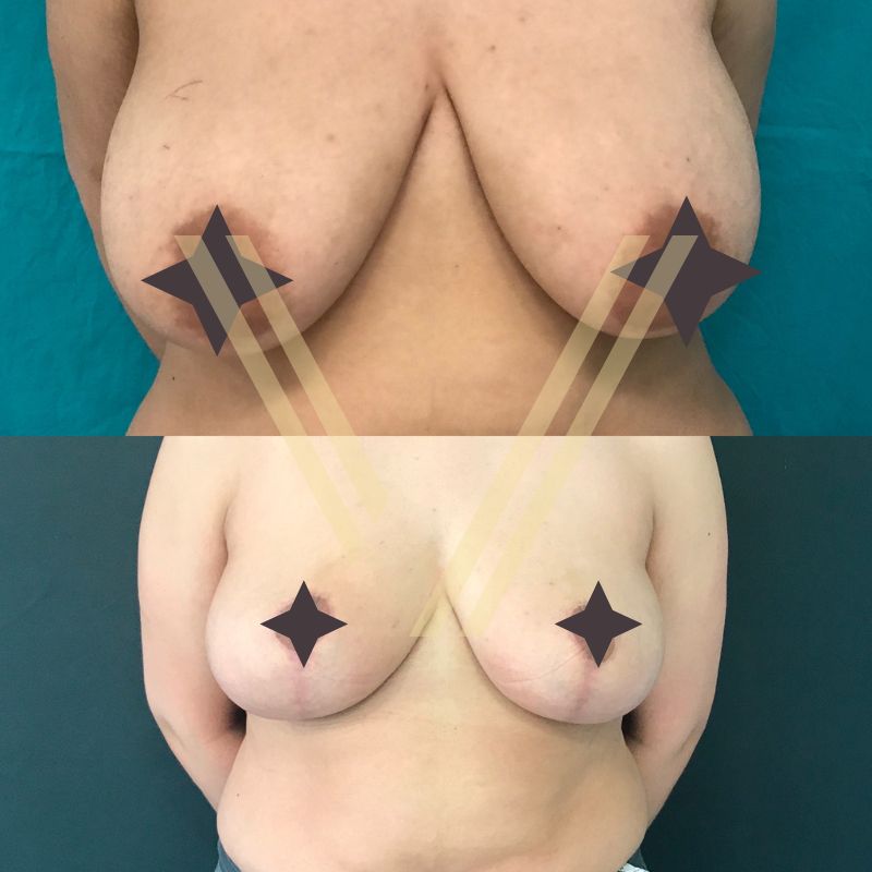breast lift and reduction operation before after photos vantage