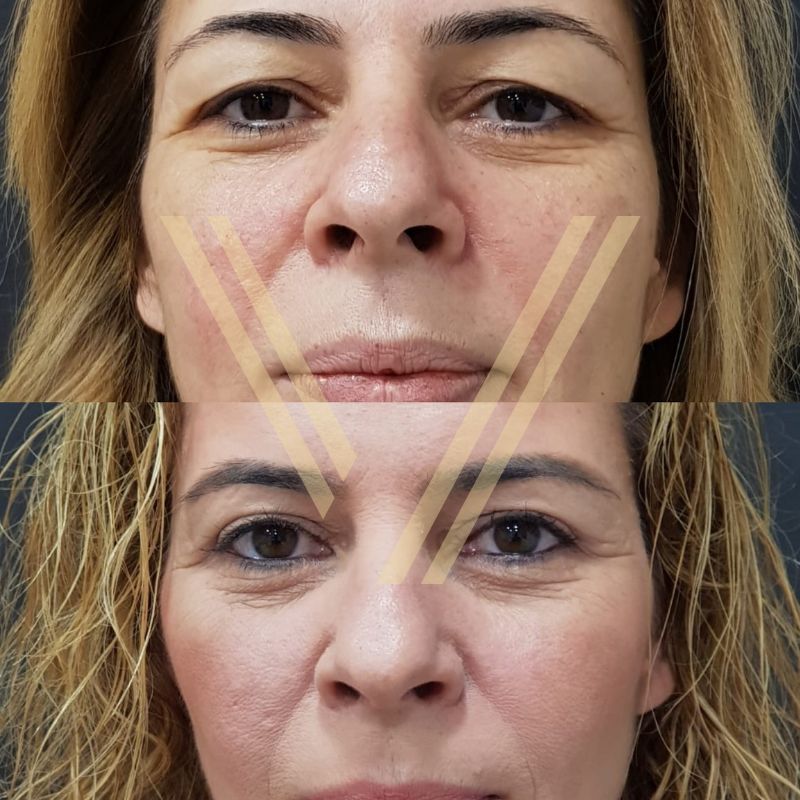 upper eyelid surgery blepharoplasty before & after female