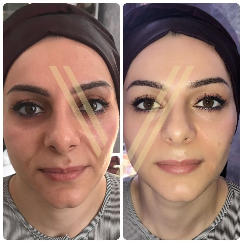 female patient nasolabial filler before after at vantage aesthetics clinic