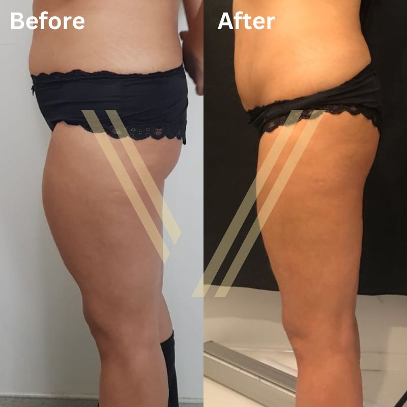 leg liposuction before and after result at vantage aesthetics clinic turkey