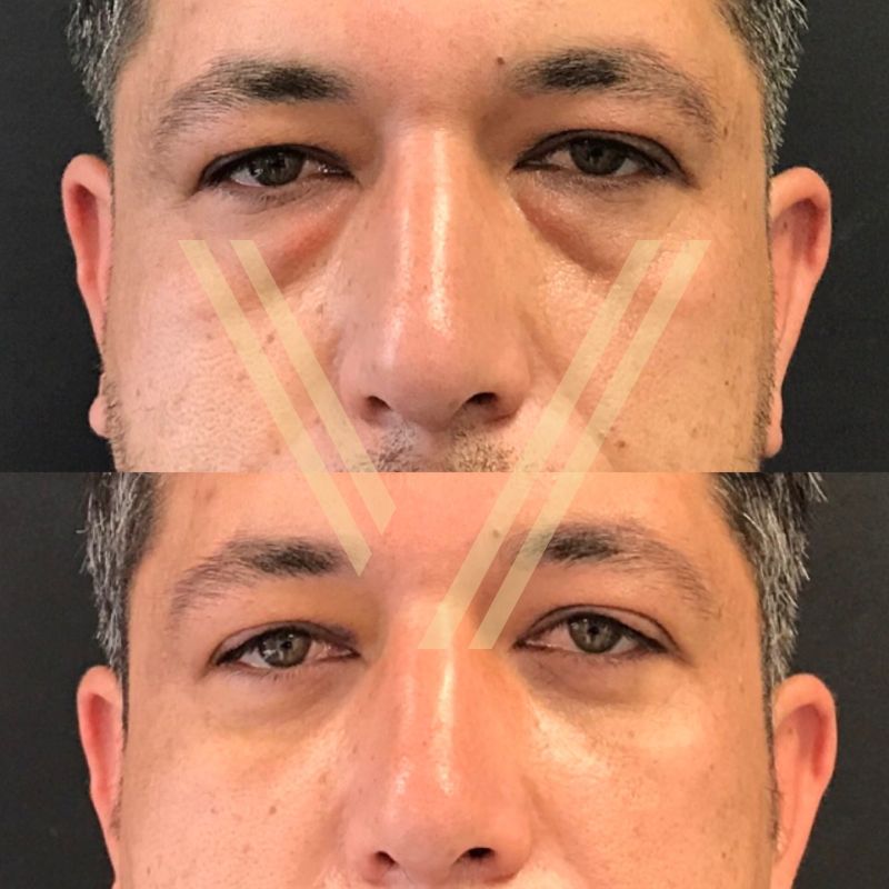 male patient lower eyelid surgery before and after