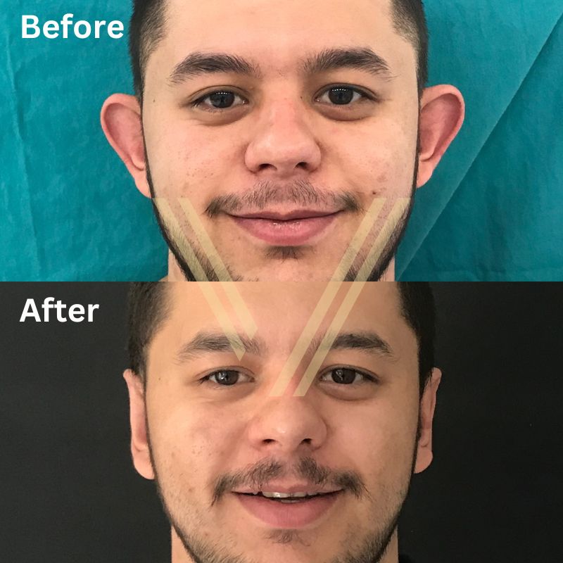 male patient otoplasty operation in Turkey before and after