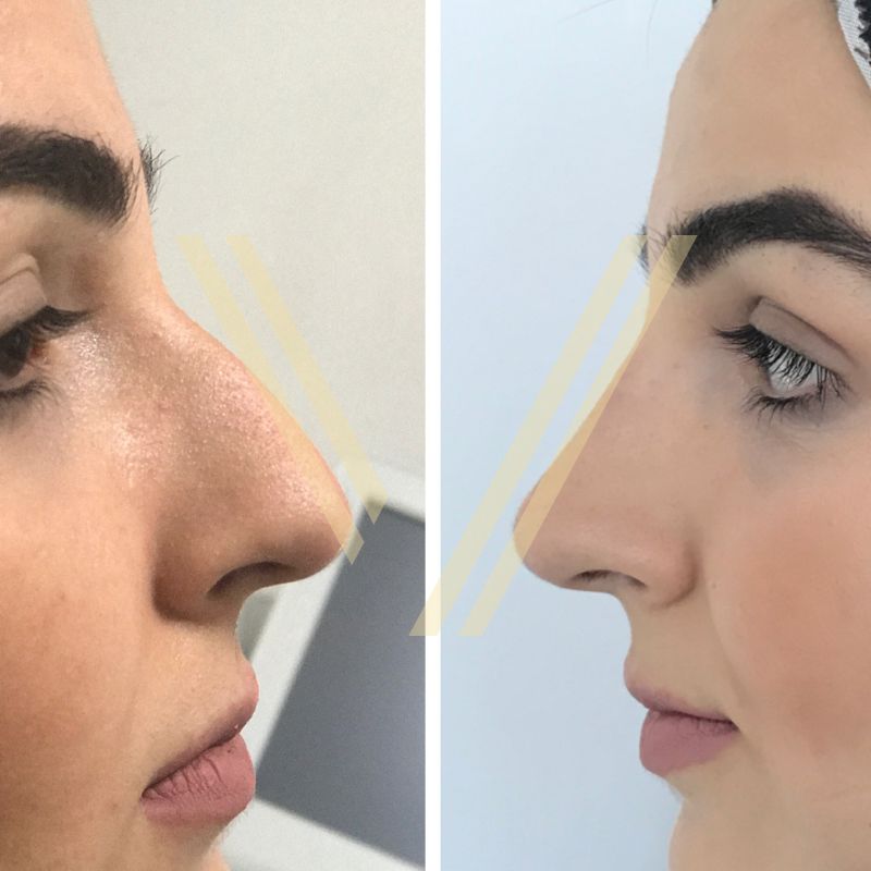 nasolabial filler before after at vantage aesthetics clinic