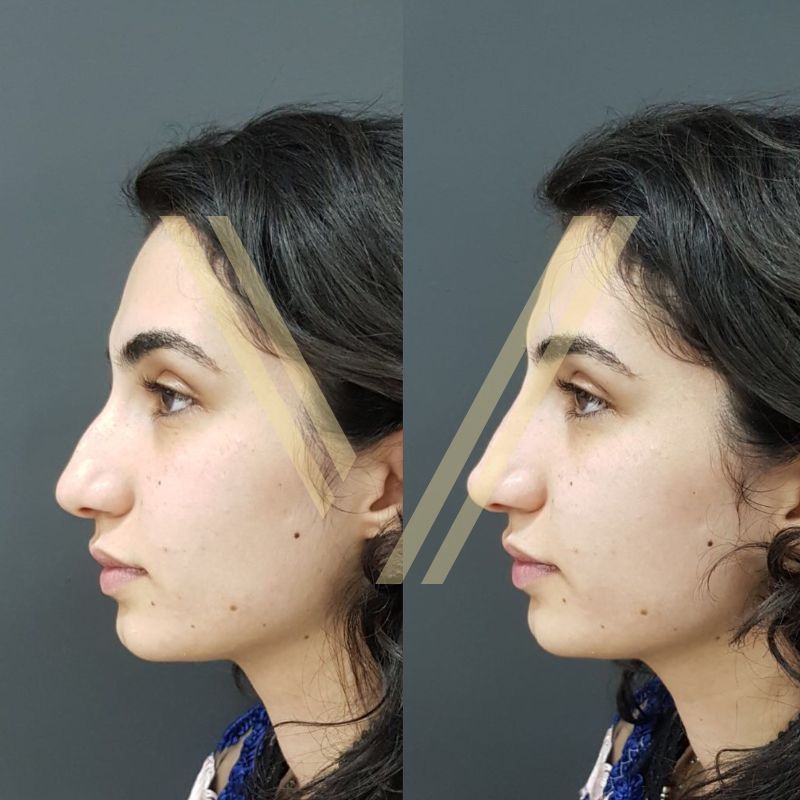 nasolabial filler before after immidiate result