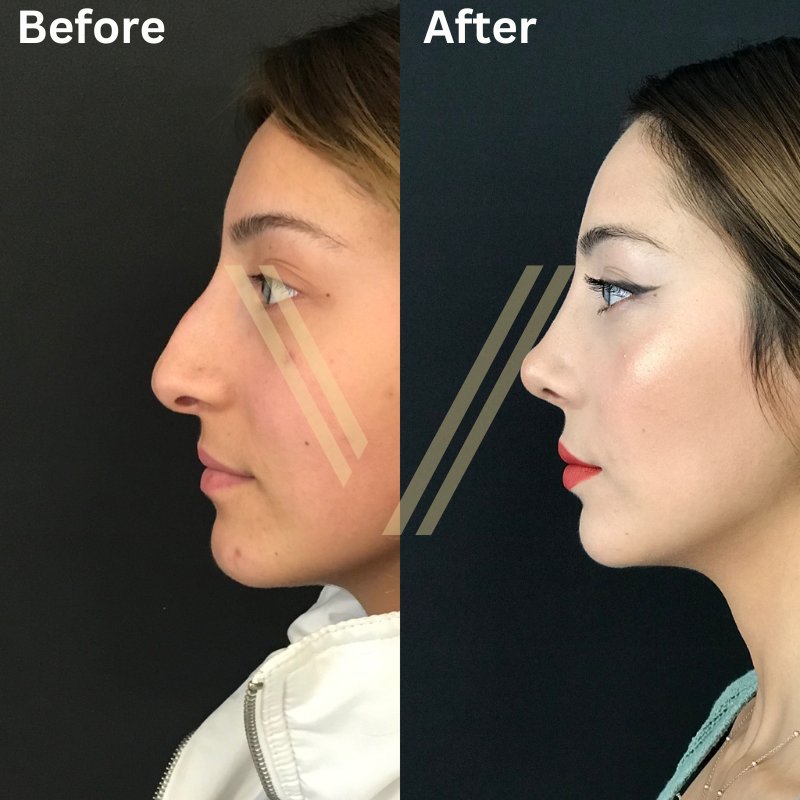 nose job before & after female patient at vantage aesthetics turkey