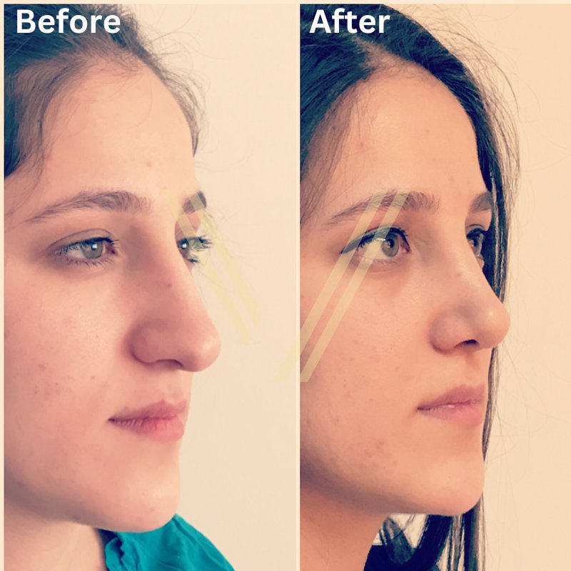 nose job before after female patient vantage aesthetics istabul