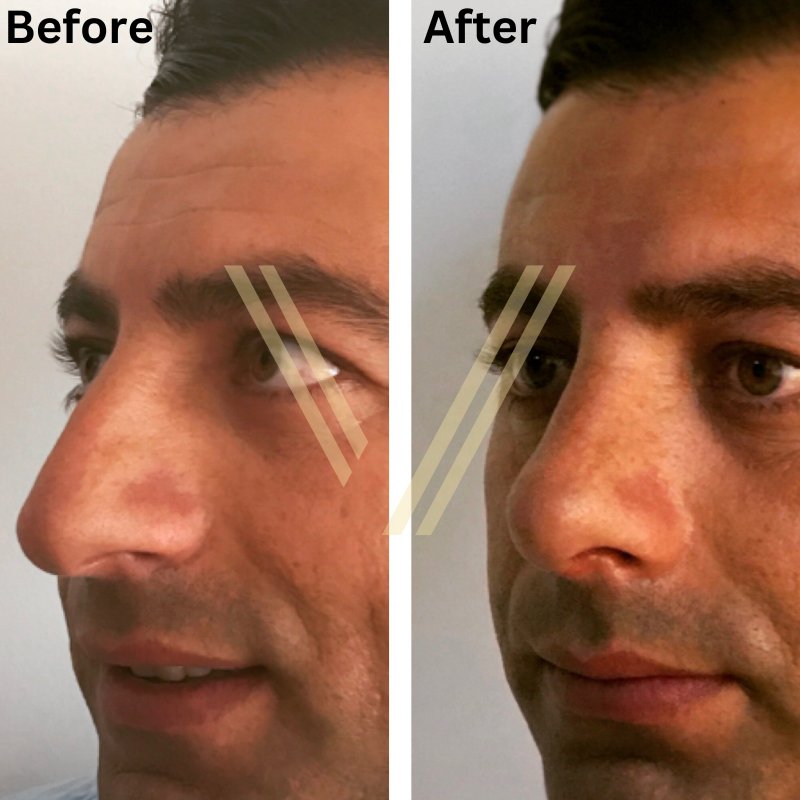 nose job before after male result