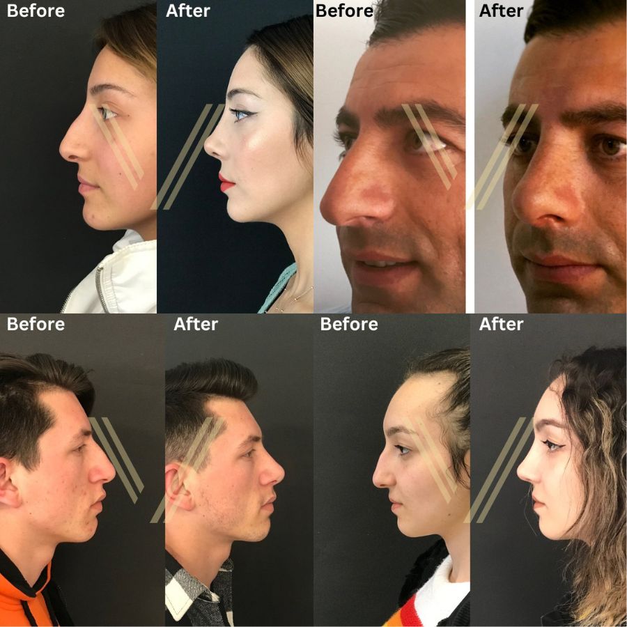 nose job before and after photos at vantage aesthetics