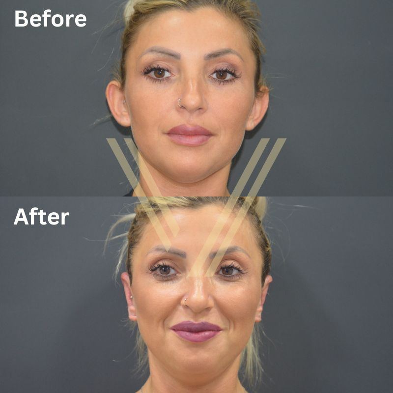 otoplasty operation Turkey before and after female patient