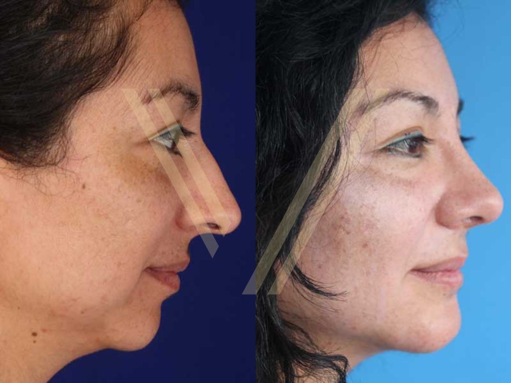 rhinoplasty and double chin before after photo