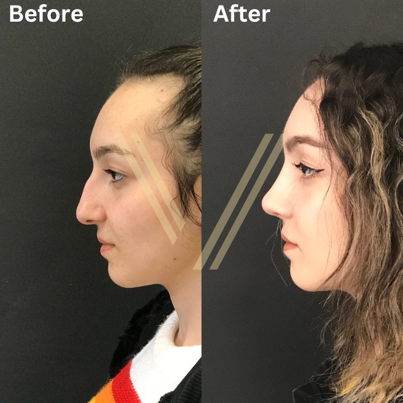rhinoplasty before and after side photos