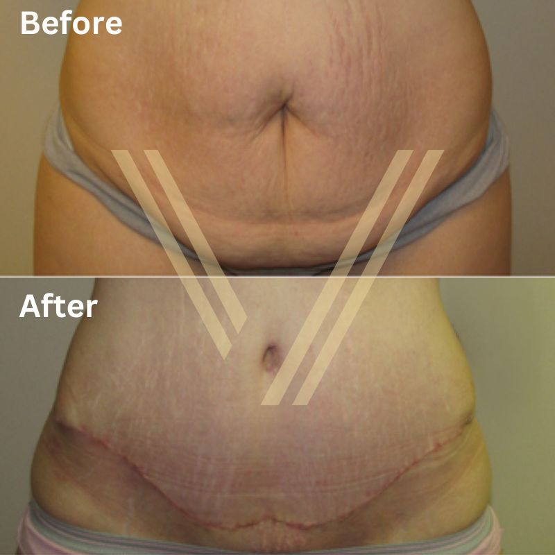 tummy tuck before and after female patient photo