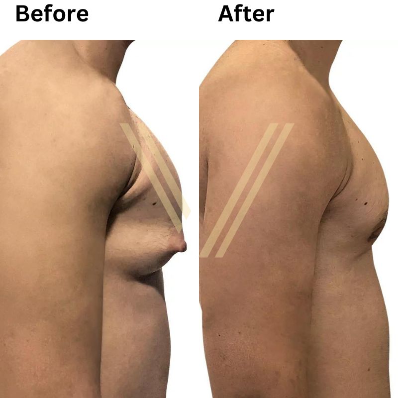 Before and after gynecomastia surgery result