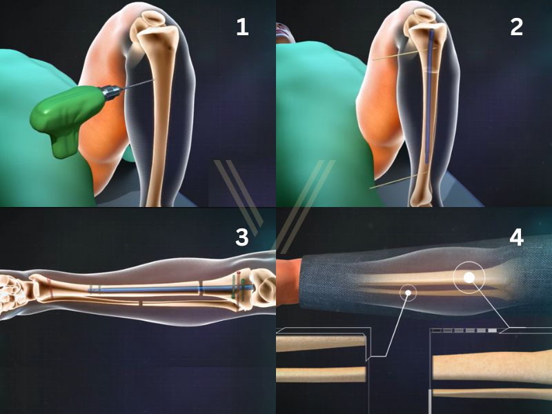 How Does Leg Lengthening Surgery Work - 4 Steps