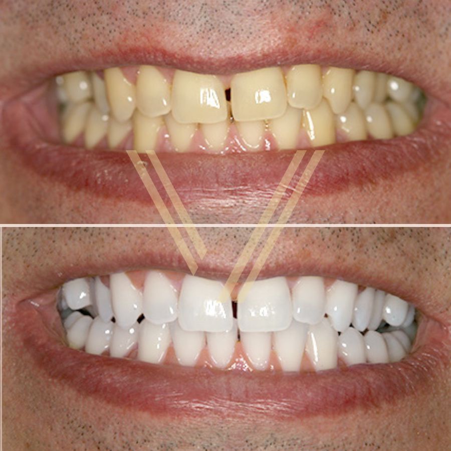 Turkey Teeth Whitening Before and After Photo