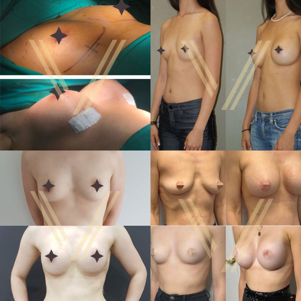 breast augmentation before and after photos 5 patients