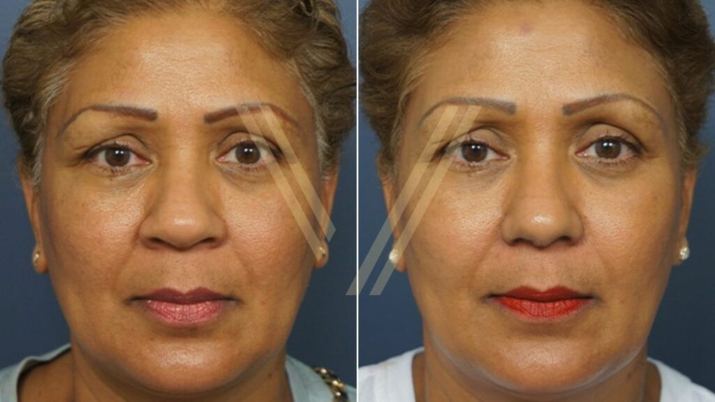 Ethnic rhinoplasty before and after - female patient