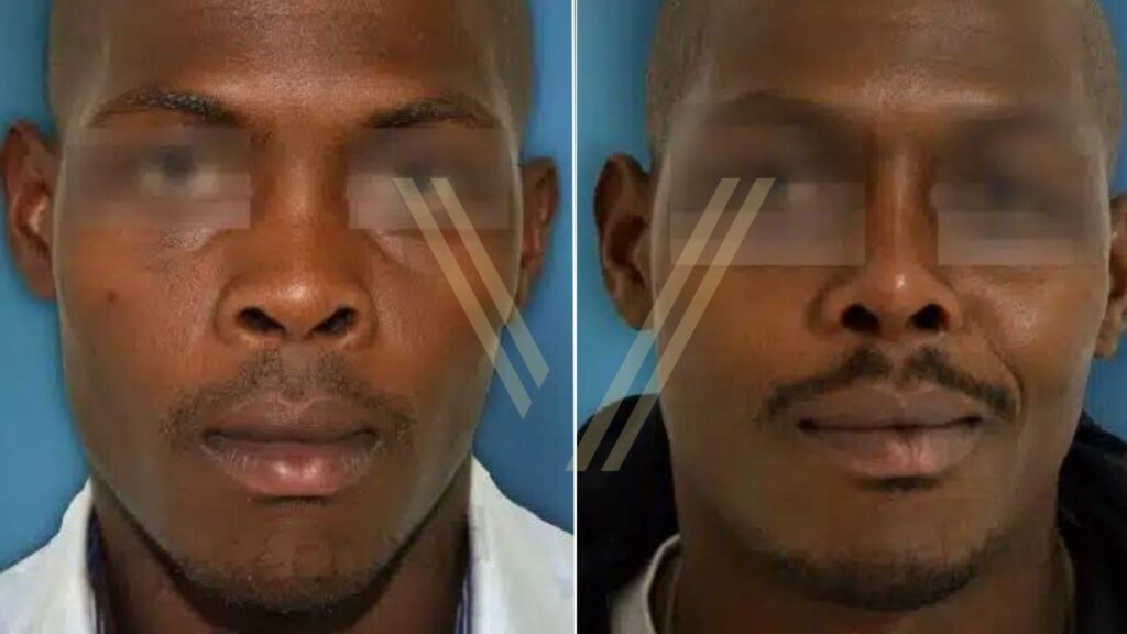 Ethnic rhinoplasty before and after - male