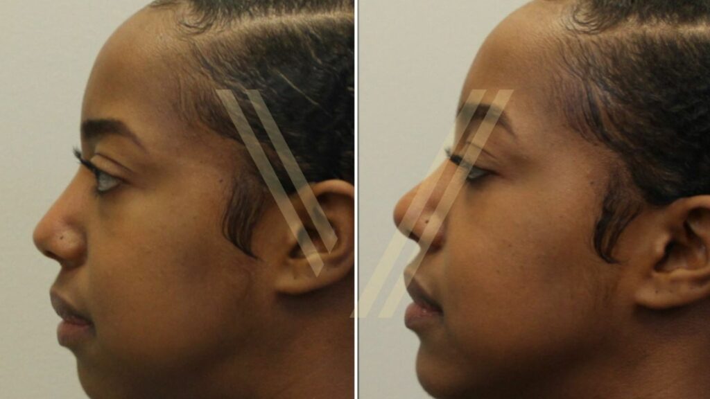 Ethnic rhinoplasty before and after photo female