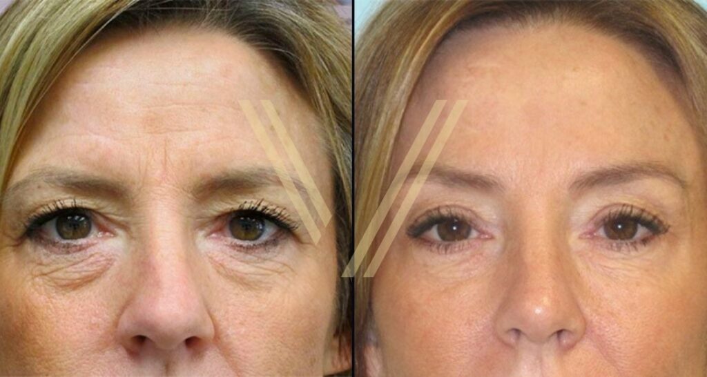 brow lift before and after picture - vantage istanbul turkey