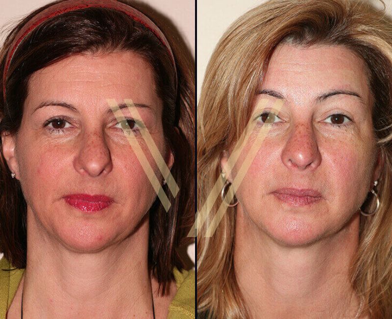 brow lift surgery in turkey - before and after result
