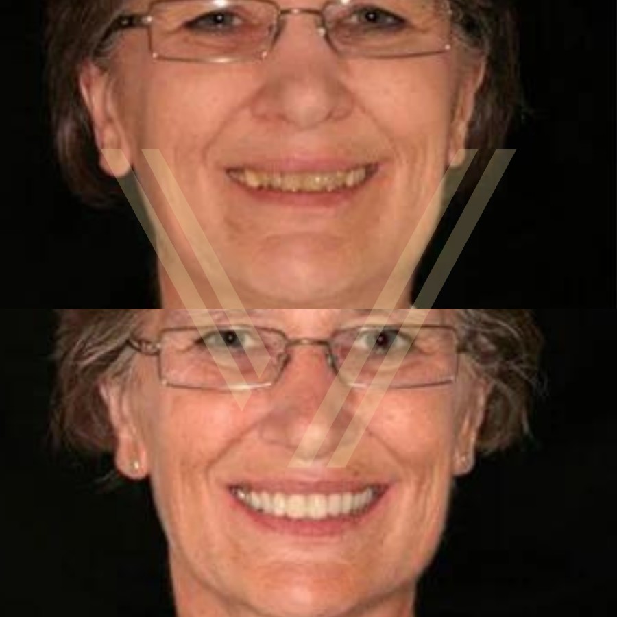 dental implant before and after female patient