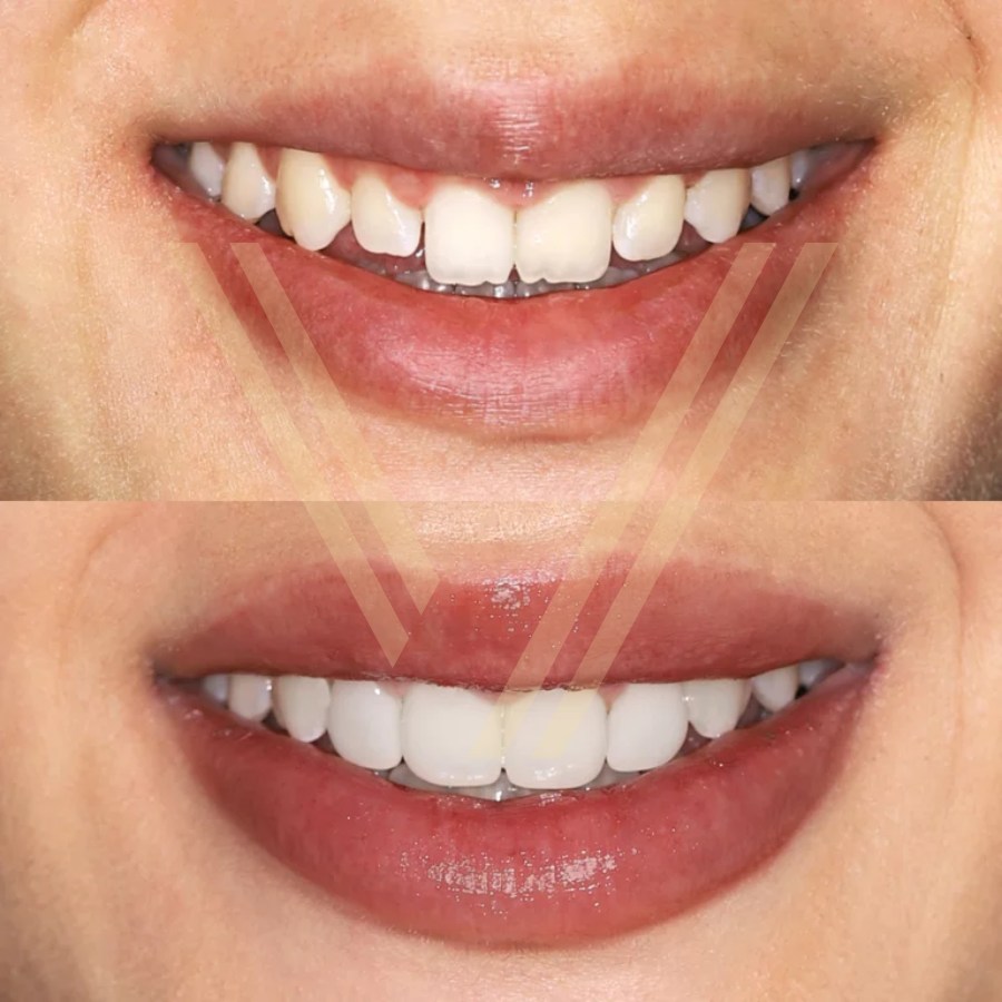 dental veneer before and after photo female