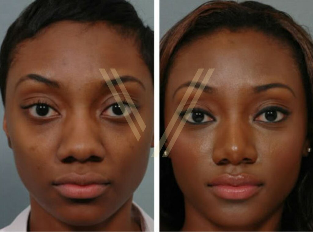 ethnic rhinoplasty - before and after photo in turkey