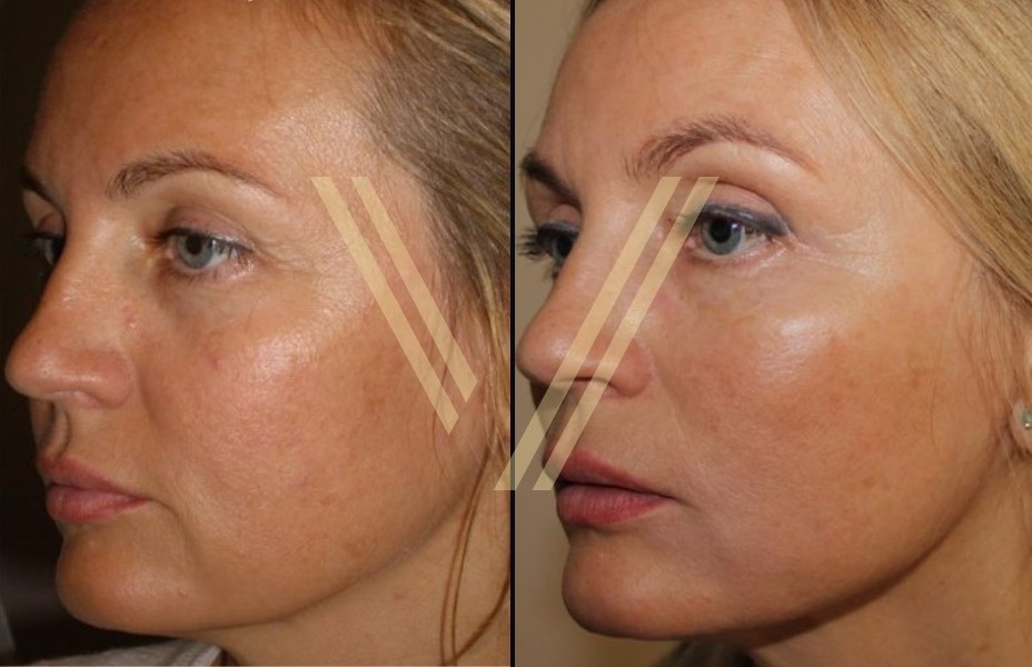 female patient brow lift surgery before & after