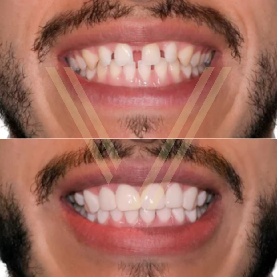 teeth veneer before and after photo