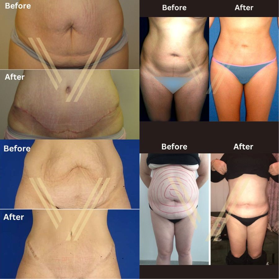 How Much Is a Tummy Tuck Cost In year 2020-2021?