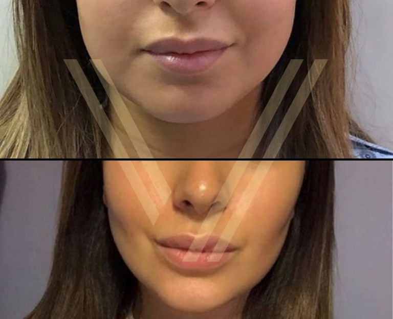 Buccal Fat Removal before after photo